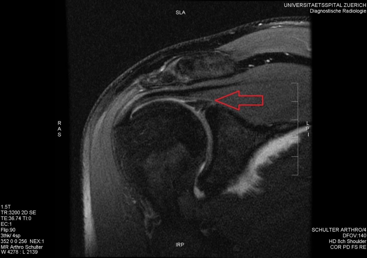 Diagnosis Glenoid Labral Tear Pogo Physio Gold Coast