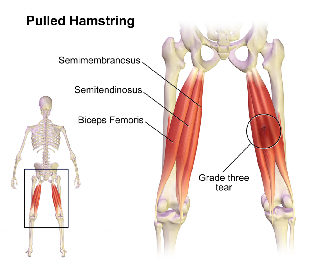 Hamstring Strain