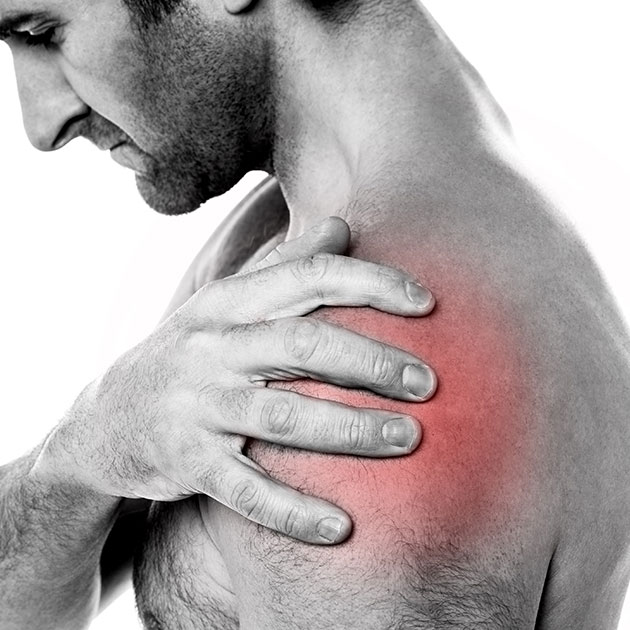 shoulder impingement