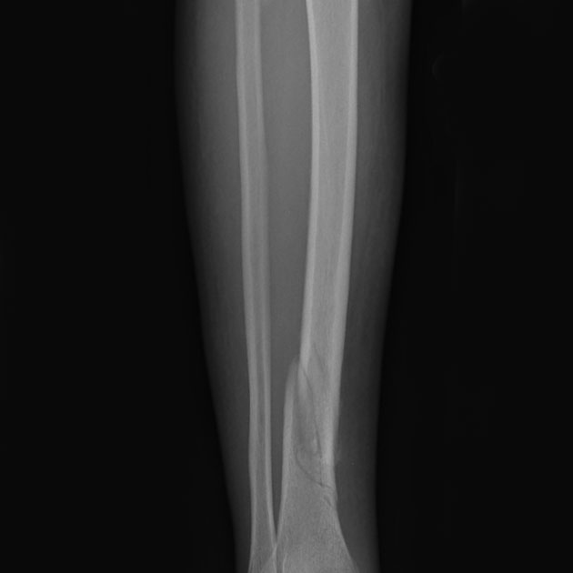 x ray stress fracture shin