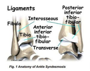 Ankle Syndesmosis Injuries | POGO Physio Gold Coast