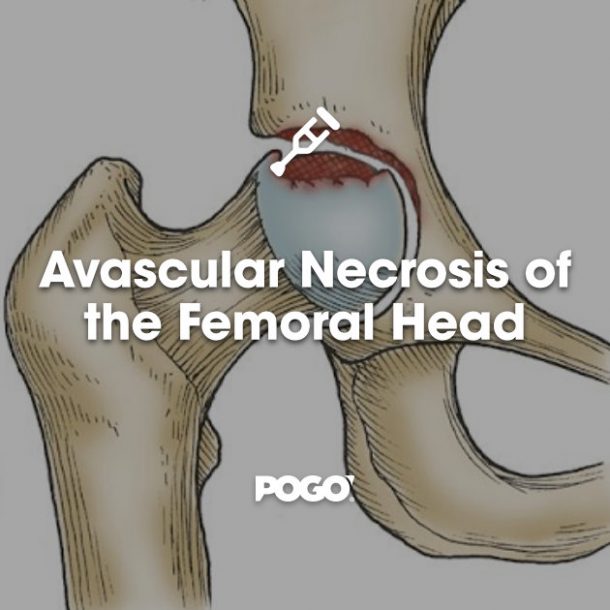 Avascular Necrosis Of The Femoral Head | POGO Physio Gold Coast