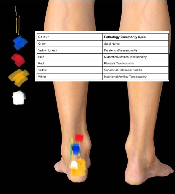 Achilles Tendon Pain - What is your diagnosis? | POGO Physio Gold Coast