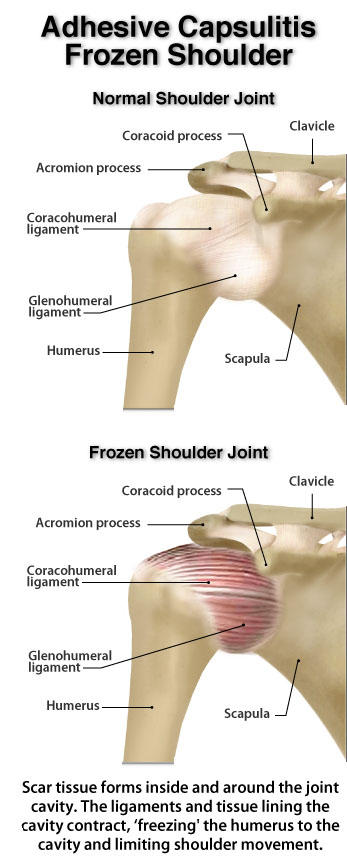 A Review of Current Frozen Shoulder Treatment Options -with Lewis Craig | POGO Physio Gold Coast