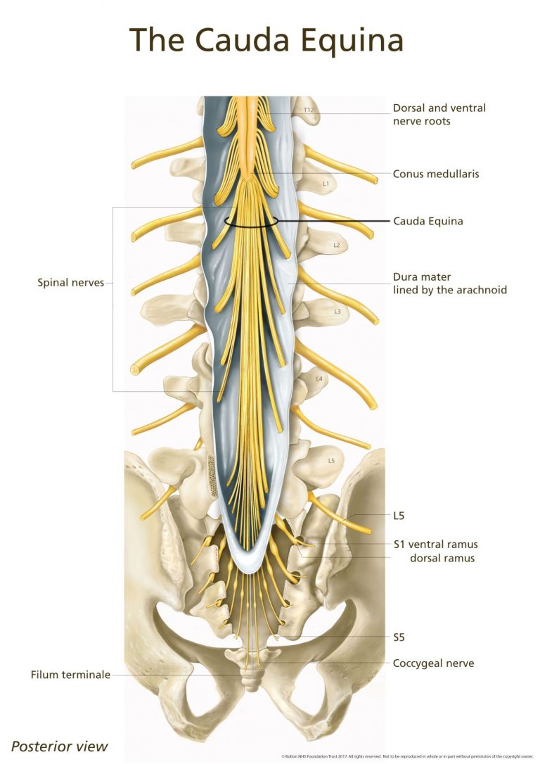 Cauda Equina Syndrome Explained Pogo Physio Gold Coast