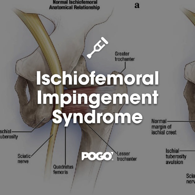 Piriformis Syndrome - Physiopedia