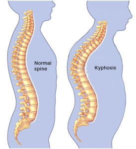 kyphosis of the spine 