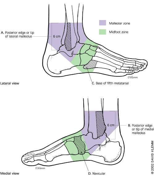 Different Types of Ankle Sprains and Implications for Recovery | POGO ...