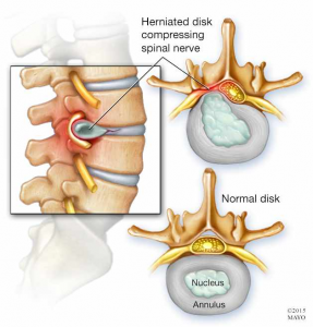 Radiculopathy: What is it and what can I do about it? | POGO Physio ...