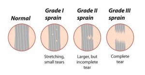 MCL Sprains Part 1 - Anatomy, Function, Mechanism Of Injury & Diagnosis ...