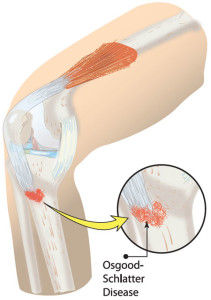 osgood schlatter disease physiotherapy 