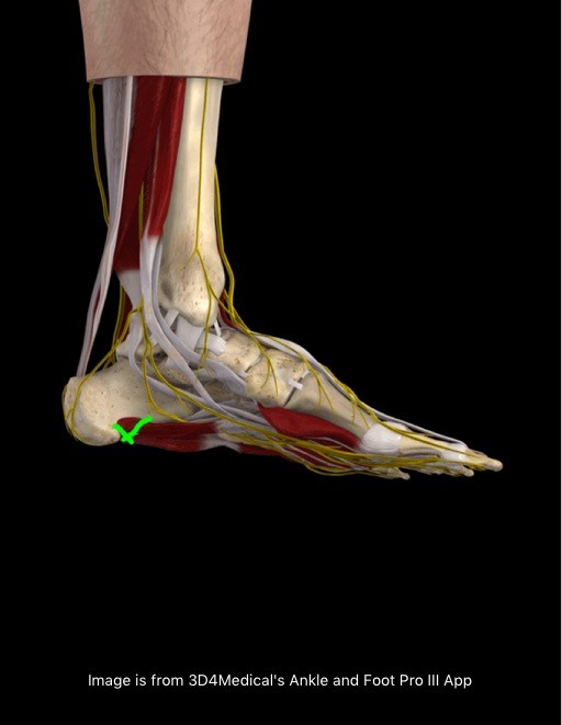 vibration therapy for plantar fasciitis