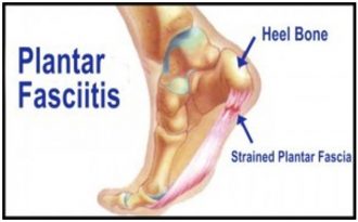 Diagnosis: Plantar Fasciitis | POGO Physio Gold Coast