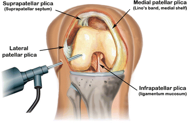 medial plica of the knee 