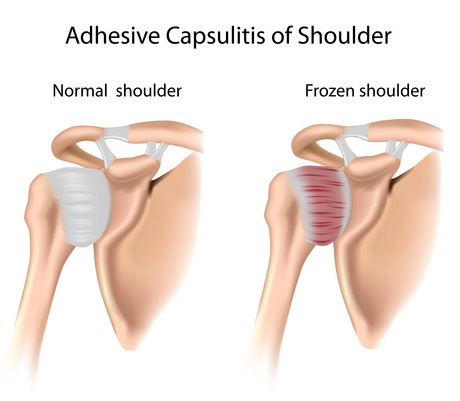Illustration of Frozen Shoulder by PogoPhysio