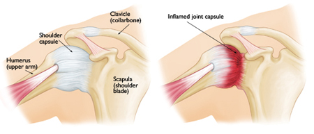 Frozen Shoulder 1 Illustration