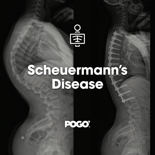 Scheuermann’s Disease | POGO Physio Gold Coast