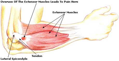 tennis-elbow anatomy