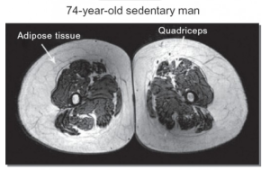74 YEAR OLD SEDENTARY MALE MR
