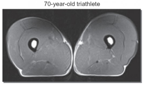 MRI of a 70 year old male triathlete 